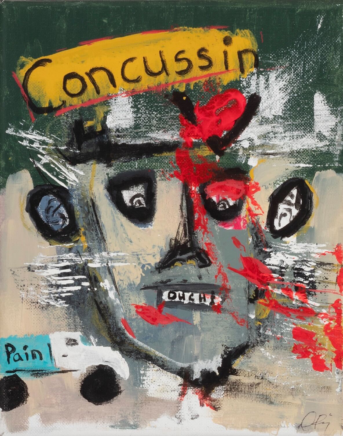 Concussin